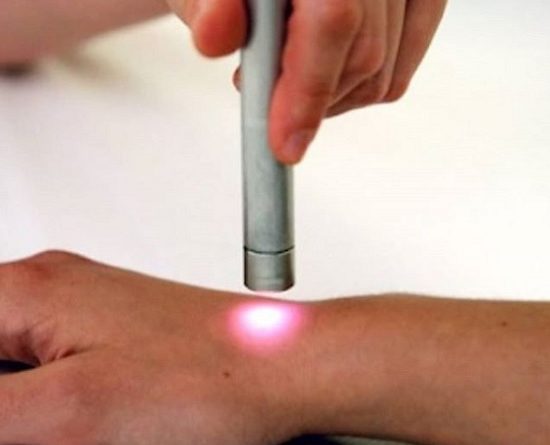 Laserterapia cos'è a cosa serve