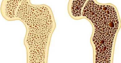 Osteoporosi cos'è sintomi trattamento
