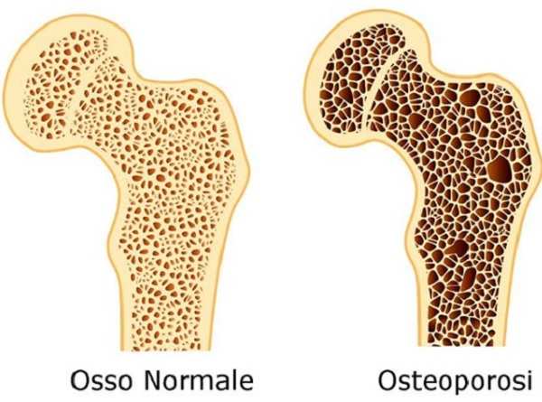 Osteoporosi cos'è sintomi trattamento