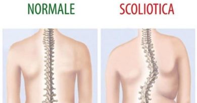 Scoliosi cos'è trattamento