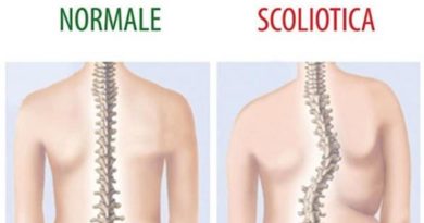 Scoliosi cos'è trattamento