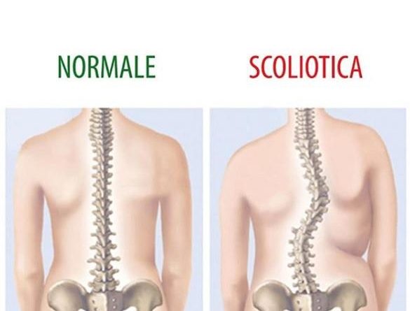 Scoliosi cos'è trattamento