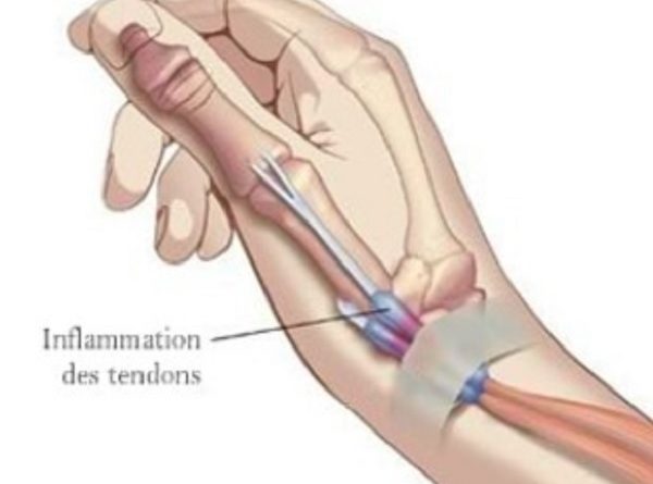 Tenosinovite di de quervain cos'è
